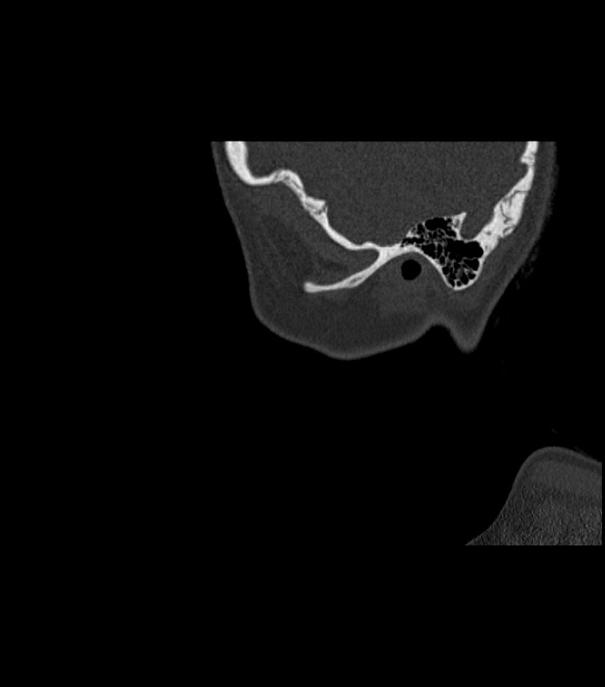 Nasoorbitoethmoid fracture (Radiopaedia 90044-107205 Sagittal bone window 18).jpg