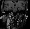 Nasopharyngeal carcinoma (Radiopaedia 4546-6667 E 14).jpg