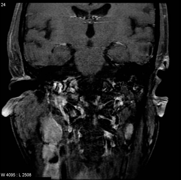 File:Nasopharyngeal carcinoma (Radiopaedia 4546-6667 E 14).jpg