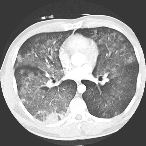 File:Near drowning pulmonary edema (Radiopaedia 16868-16591 Axial lung window 27).jpg