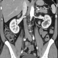 Necrotizing pancreatitis with acute necrotic collection (Radiopaedia 14470-14417 C 24).jpg