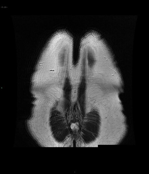 File:Neurofibromatosis type 1 (Radiopaedia 36933-38560 Coronal T2 28).jpg