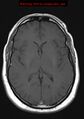 Neuroglial cyst (Radiopaedia 10713-11184 Axial T1 11).jpg