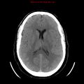 Neuroglial cyst (Radiopaedia 10713-11185 Axial non-contrast 15).jpg