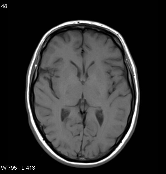 File:Neurosarcoidosis (Radiopaedia 10930-11351 Axial T1 10).jpg