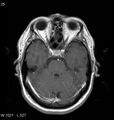 Neurosarcoidosis (Radiopaedia 10930-11351 Axial T1 C+ 6).jpg