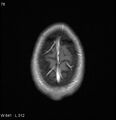 Neurosarcoidosis (Radiopaedia 10930-17204 Axial T1 C+ 19).jpg