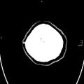Neurotoxoplasmosis - concentric target sign (Radiopaedia 70644-80783 Axial non-contrast 41).jpg