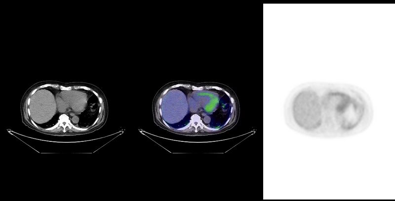 File:Non-Hodgkin lymphoma involving seminal vesicles with development of interstitial pneumonitis during Rituximab therapy (Radiopaedia 32703-33761 ax CT Fus PET 24).jpg