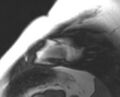 Non-compaction of the left ventricle (Radiopaedia 69436-79314 Short axis cine 7).jpg