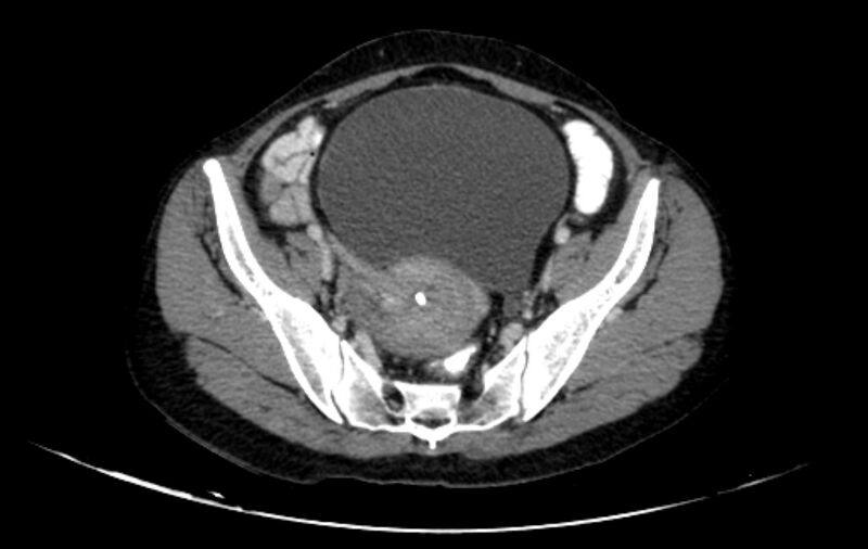 File:Non-puerperal uterine inversion (Radiopaedia 78343-91094 A 5).jpg