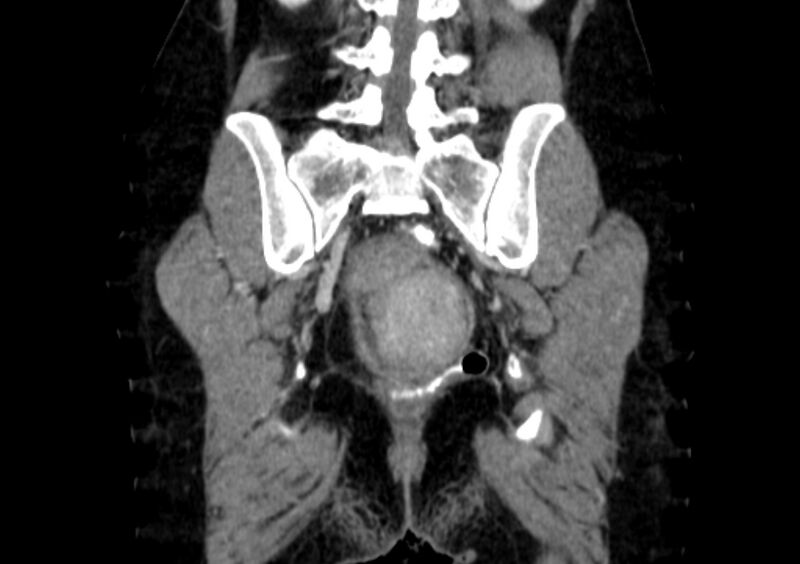File:Non-puerperal uterine inversion (Radiopaedia 78343-91094 B 48).jpg