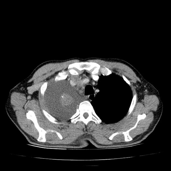 File:Non small-cell lung cancer (Radiopaedia 24467-24769 C+ delayed 14).jpg