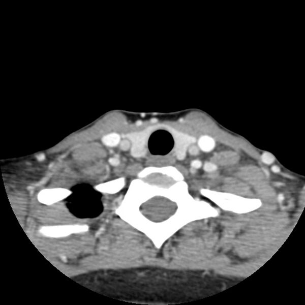 File:Normal CT of the neck (Radiopaedia 14575-14500 Axial C+ 55).jpg