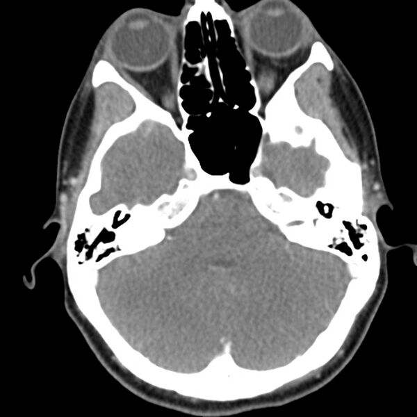File:Normal CT of the neck (Radiopaedia 14575-14500 Axial C+ 9).jpg