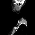 Normal CT of the neck (Radiopaedia 14575-14500 Sagittal C+ 8).jpg