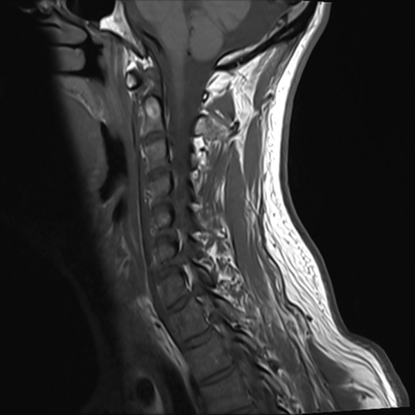 File:Normal MRI cervical spine (infection protocol) (Radiopaedia 53916-60039 Sagittal T1 10).png