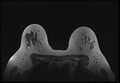 Normal breast MRI - dense breasts (Radiopaedia 80454-93850 Axial T1 161).jpg