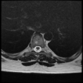 Normal cervical and thoracic spine MRI (Radiopaedia 35630-37156 H 25).png