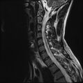 Normal cervical spine MRI (Radiopaedia 38418-40496 Sagittal T2 9).jpg