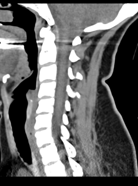 File:Normal cervical spine MRI (including Dixon) (Radiopaedia 42762-45926 C 28).png