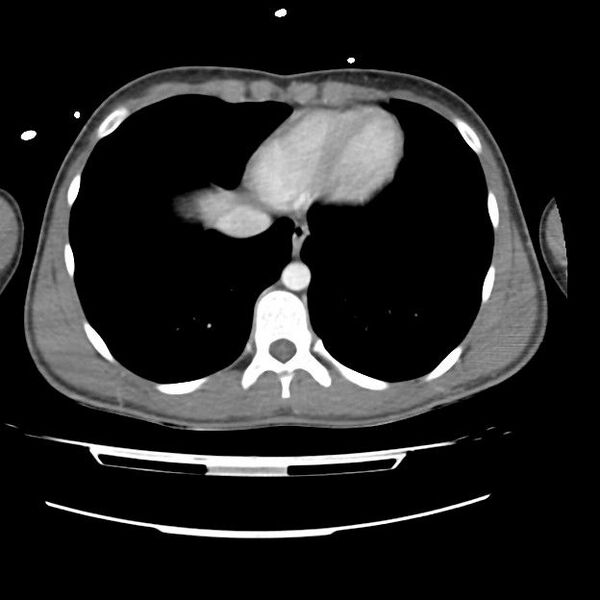 File:Normal dual-phase trauma CT chest,abdomen and pelvis (Radiopaedia 48092-52899 A 42).jpg