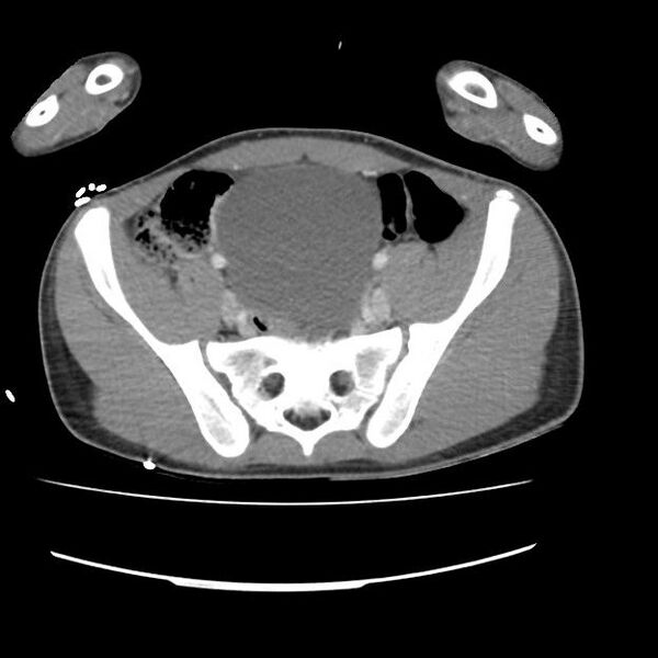 File:Normal dual-phase trauma CT chest,abdomen and pelvis (Radiopaedia 48092-52899 A 94).jpg