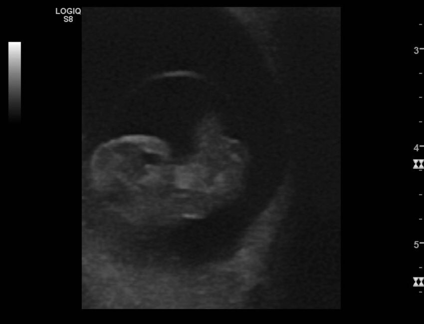 Normal early pregnancy - 8w0d (Radiopaedia 44715-48492 Longitudinal 60).jpg