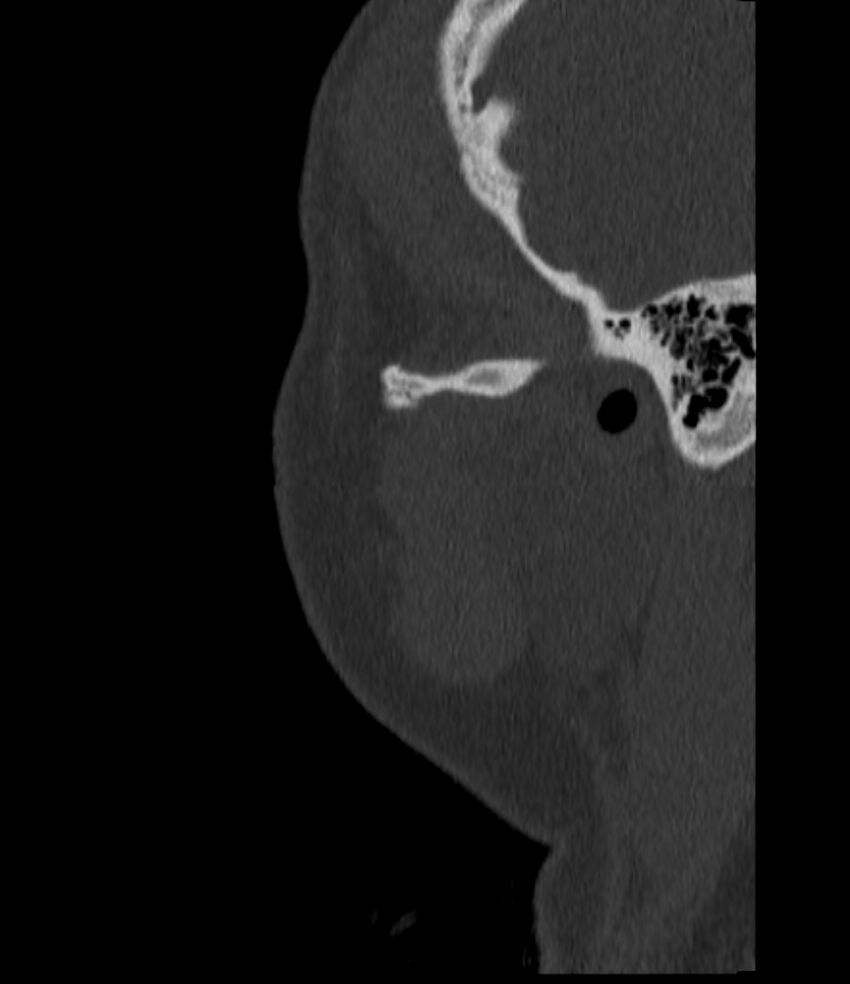 Normal facial bone CT (Radiopaedia 88742-105476 Sagittal bone window 150).jpg