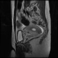 Normal female pelvis MRI (retroverted uterus) (Radiopaedia 61832-69933 Sagittal T2 22).jpg