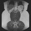 Normal liver MRI with Gadolinium (Radiopaedia 58913-66163 Coronal T2 34).jpg