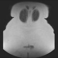 Normal liver MRI with Gadolinium (Radiopaedia 58913-66163 Coronal T2 41).jpg