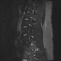 Normal lumbar spine MRI (Radiopaedia 47857-52609 Sagittal STIR 15).jpg