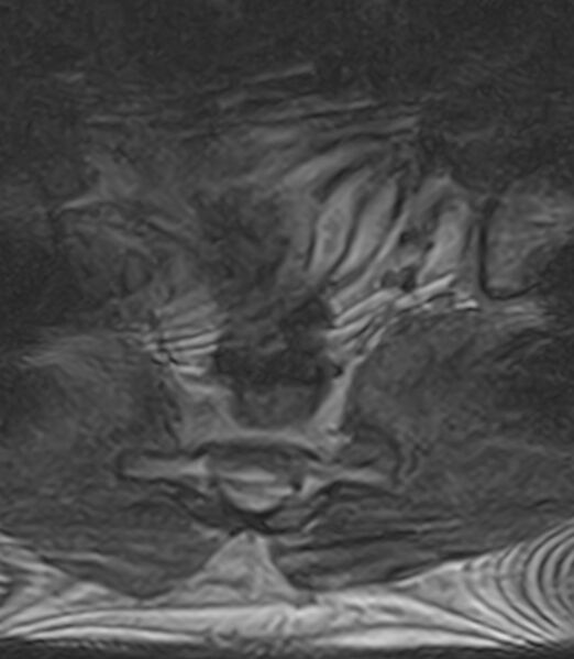 File:Normal lumbar spine MRI - low-field MRI scanner (Radiopaedia 40976-43699 Axial T2 107).jpg