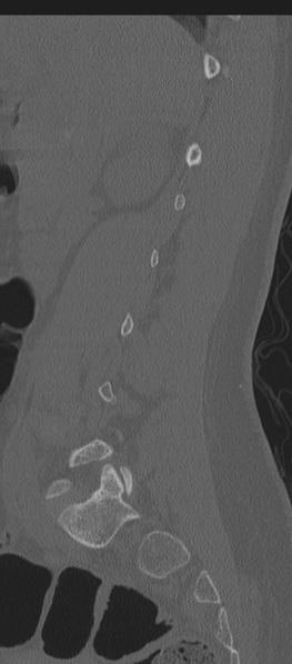 File:Normal lumbosacral CT (Radiopaedia 37923-39867 Sagittal bone window 67).png