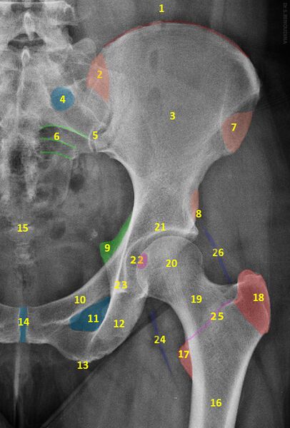 File:Normal radiographic anatomy of the hip (Radiopaedia 50575-56007 Frontal 1).jpg
