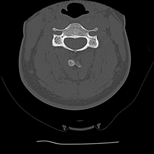 File:Normal trauma spine imaging (Radiopaedia 31753-32686 Axial bone window 37).jpg