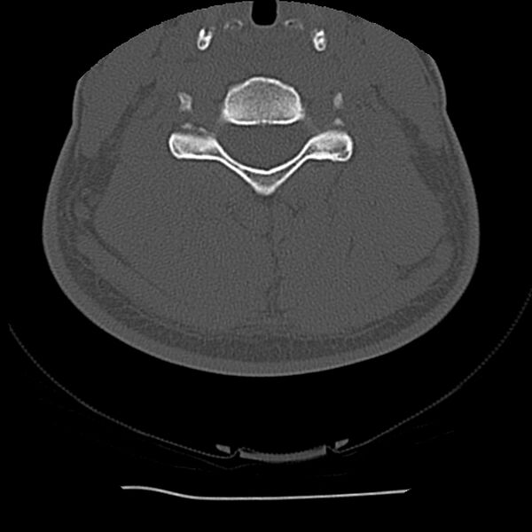 File:Normal trauma spine imaging (Radiopaedia 31753-32686 Axial bone window 49).jpg