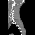 Normal trauma spine imaging (age 16) (Radiopaedia 45335-49358 C 32).jpg