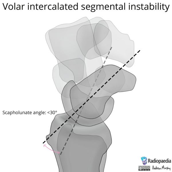 File:Normal wrist alignment, dorsal and volar intercalated segmental instability (illustration) (Radiopaedia 80949-94486 A 11).png