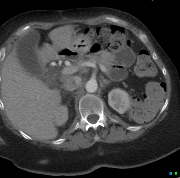 File:Obstructed infected horseshoe kidney (Radiopaedia 18116-17898 B 1).jpg