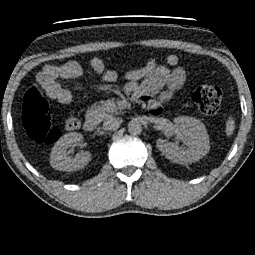 Obstructing ureteric calculus and ureteric anatomy (Radiopaedia 62730-71042 Axial non-contrast 35).jpg