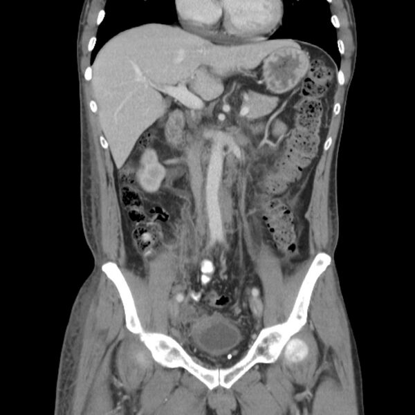 File:Obstructive bladder transitional cell carcinoma (Radiopaedia 9825-10410 B 9).jpg