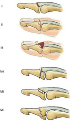 Doyle classification of mallet fingers[6]