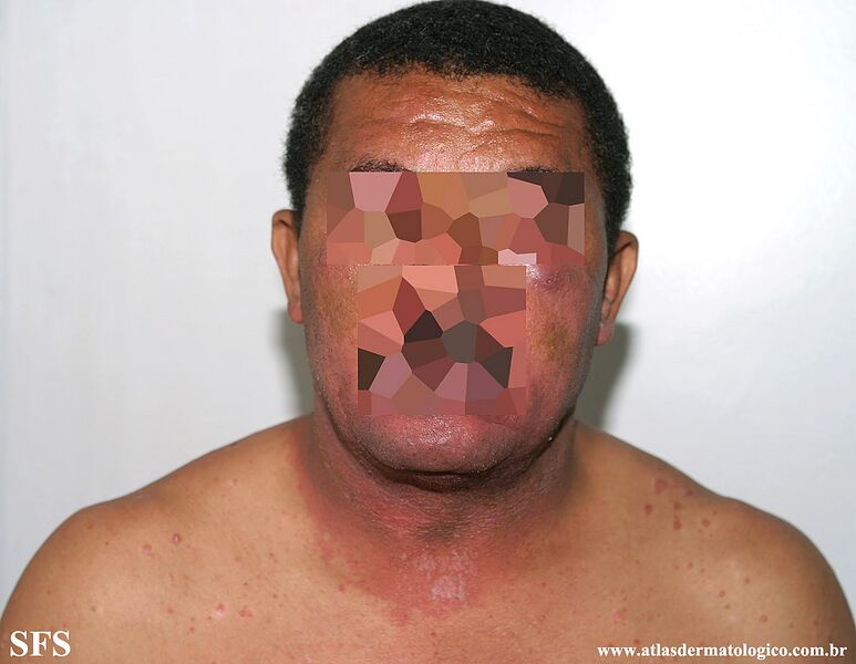 File:Psoriasis (Dermatology Atlas 115).jpg