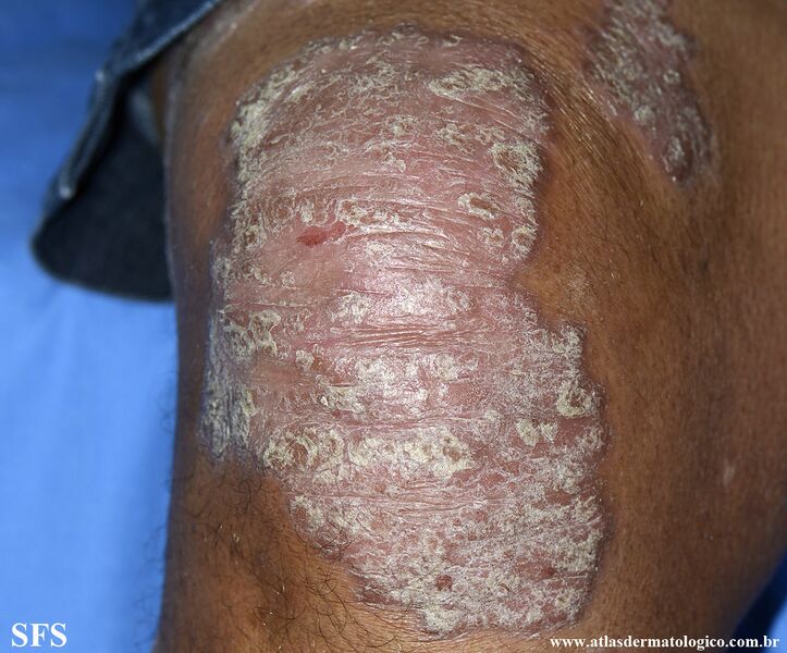 File:Psoriasis (Dermatology Atlas 153).jpg