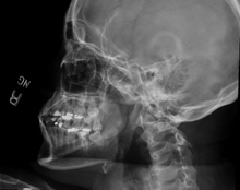 Jaw dislocation following relocation
