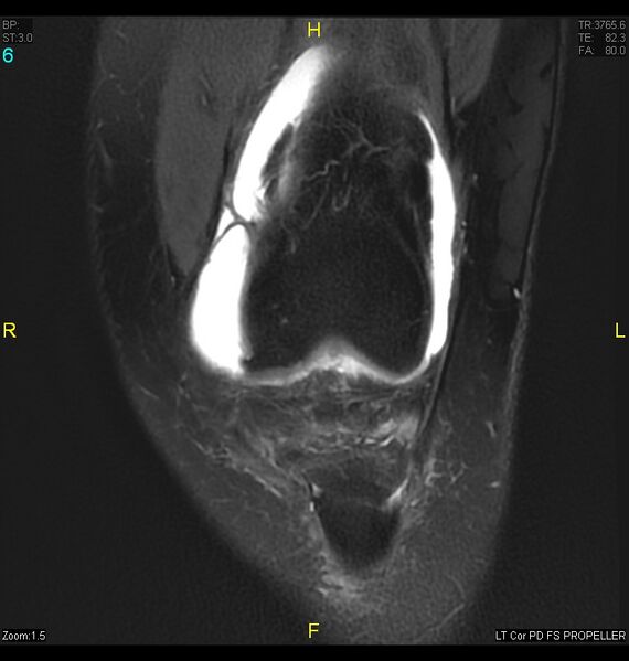File:ACL mucoid degeration with cystic changes (Radiopaedia 48428-53341 Coronal PD fat sat 3).jpg