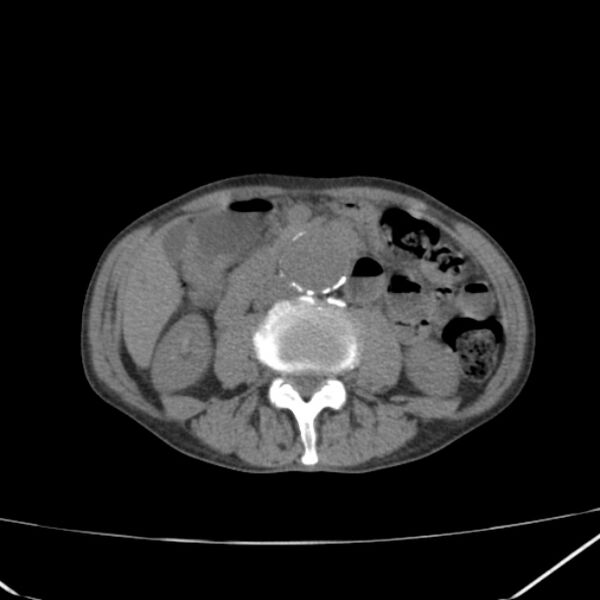 File:Abdominal aortic aneurysm (Radiopaedia 23703-23856 Axial non-contrast 27).jpg