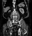Abdominal aortic aneurysm (Radiopaedia 25855-26001 Coronal C+ arterial phase 56).jpg